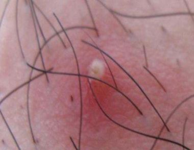 什么是毛囊炎 毛囊炎是怎么引起的