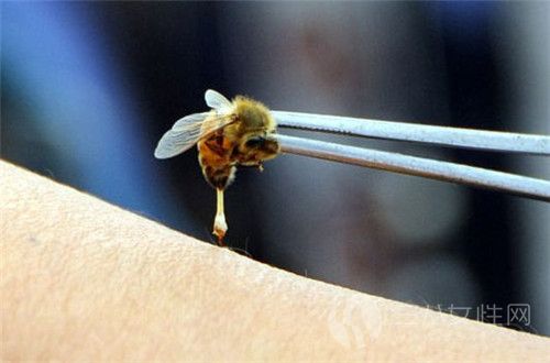 被蜜蜂蜇伤怎么办