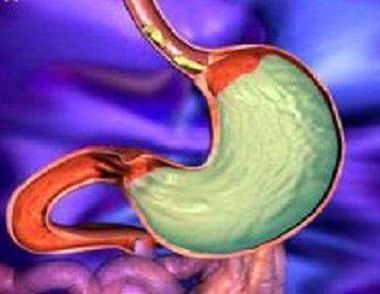 胃食管反流有什么症状 胃食管反流是怎样引起的