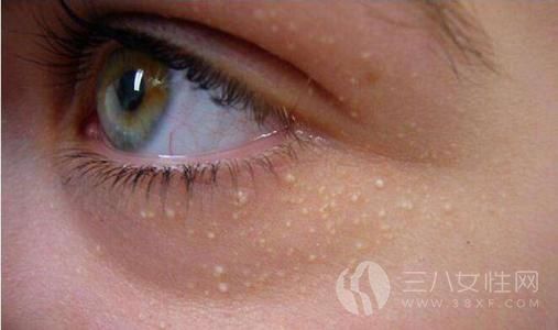 眼睛周圍為什麼會長脂肪粒 眼睛周圍長脂肪粒是什麼原因
