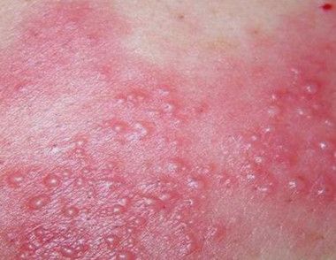 带状疱疹有什么表现 怎样预防带状疱疹