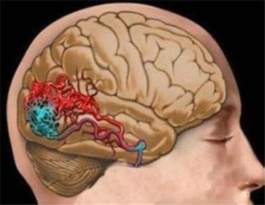 脑溢血是怎么引起的 脑溢血有哪些影响