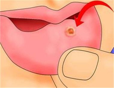 口腔溃疡是怎么形成的 口腔溃疡如何护理