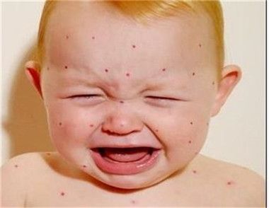 秋季孩子患上荨麻疹怎么办 秋季孩子患上荨麻疹要注意什么