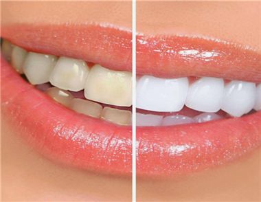 美白牙貼的使用方法是什麼 美白牙貼多久用一次比較好