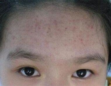 額頭長痘痘的原因有哪些 額頭上的痘痘怎麼消