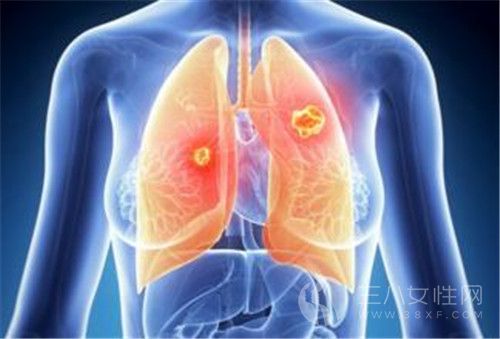 肺癌的早期症状有哪些