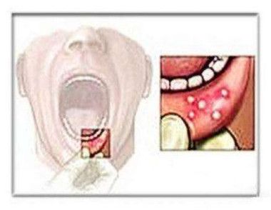 口腔溃疡吃什么好的快 引起口腔溃疡的原因是什么