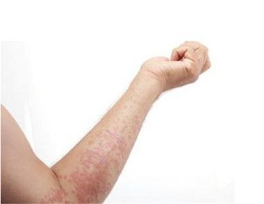 長濕疹是什麼原因 夏季如何預防濕疹