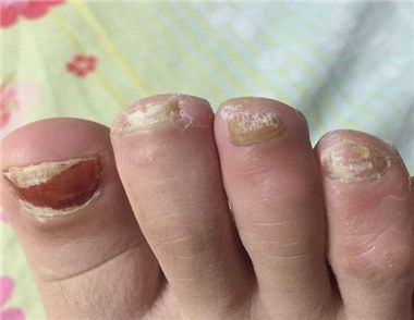 灰指甲有什么危害 灰指甲的治疗方法有哪些