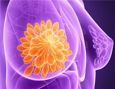 乳腺囊腫如何治療 乳腺囊腫會不會癌變