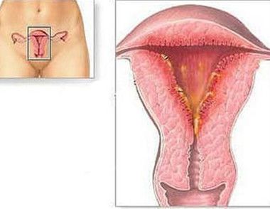 女性子宮偏大怎麼調理 導致子宮偏大的原因有哪些