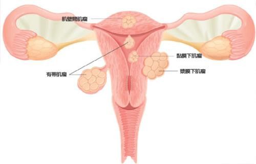 子宫肌瘤是怎么引起的