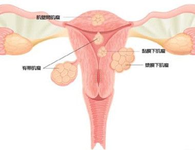 子宮肌瘤不能吃什麼 女性得了子宮肌瘤如何調理