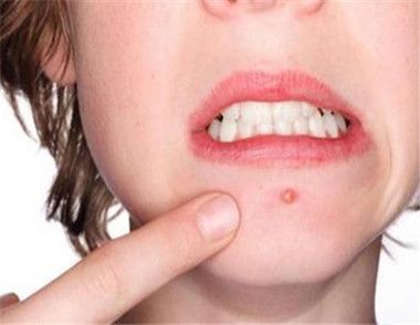 嘴巴邊長痘是什麼原因 嘴巴邊長痘該怎麼去除