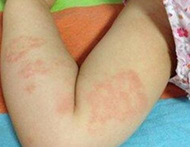 小兒風疹的症狀 小兒風疹怎樣好得快