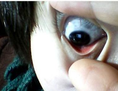 ​眼白上有黑斑怎么回事 眼白上的黑斑是什么