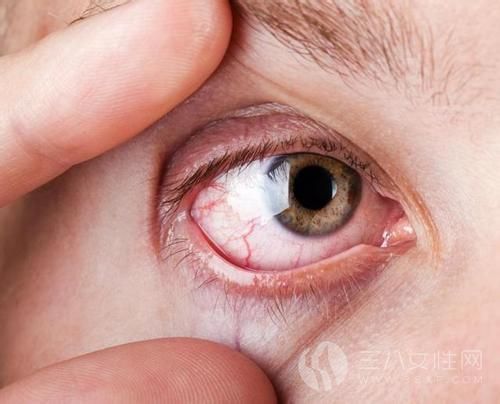 哪些习惯会导致眼睛里有红血丝