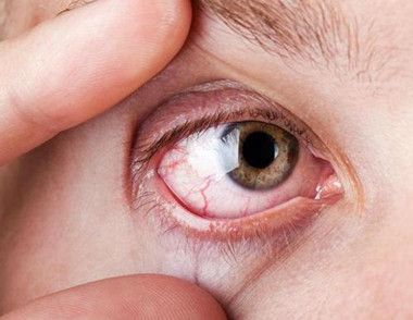 眼睛紅血絲是怎麼回事 眼睛裏的紅血絲如何消除