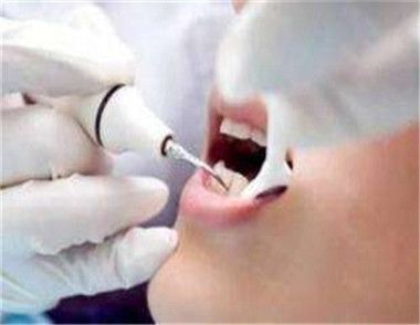 什么情况要洗牙 牙医是怎么洗牙