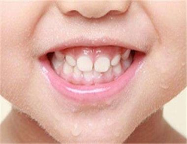 小孩換牙怎麼護理牙齒 換牙期護理有什麼注意事項