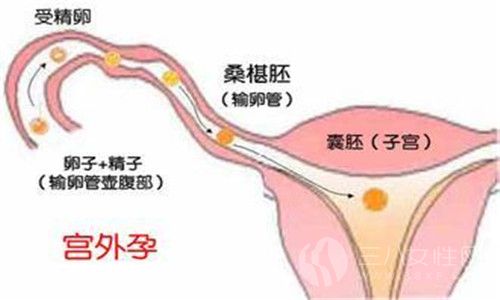 造成宫外孕的原因有哪些