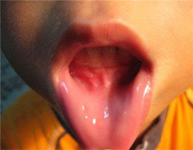 口腔溃疡有哪些原因 口腔溃疡的病因有哪些