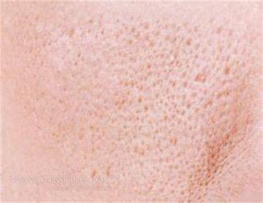 皮膚暗黃毛孔粗大怎麼辦 哪些方法可以防止皮膚暗黃毛孔粗大