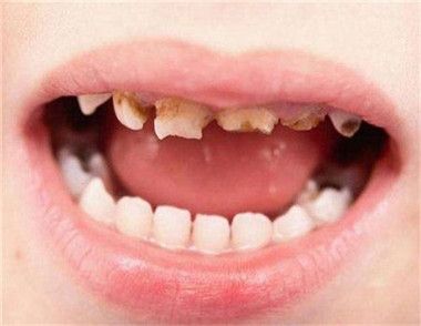 ​儿童龋齿影响换牙吗 儿童龋齿有哪些危害