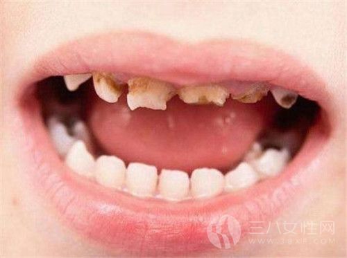 儿童龋齿影响换牙吗.jpg