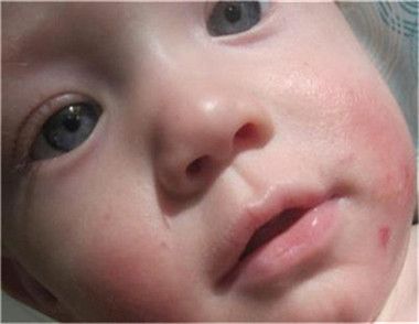 寶寶臉上為什麼長濕疹 寶寶臉上長濕疹怎麼辦