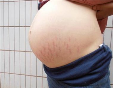 孕婦妊娠紋是什麼原因 孕婦妊娠紋怎麼消除