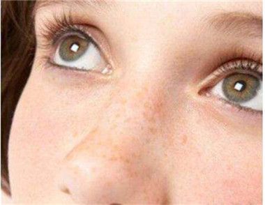 曬斑是黃褐斑嗎 曬斑和黃褐斑怎麼區分
