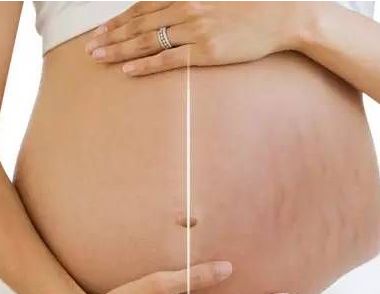 什么是妊娠纹 怎么预防孕妇长妊娠纹