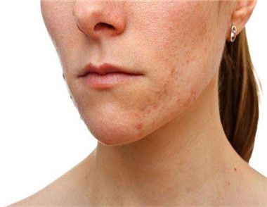 面部皮肤过敏能自愈吗 面部皮肤过敏都说是什么原因引起的