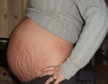 孕妇妊娠纹能去掉吗 孕妇怎么去除妊娠纹