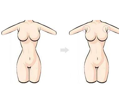 什么是副乳 副乳是怎么形成的