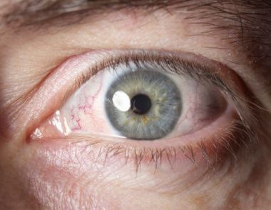 眼睛有红血丝怎么办 眼睛有红血丝的原因是什么