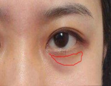 女人黑眼圈是怎么引起的 黑眼圈怎么消除