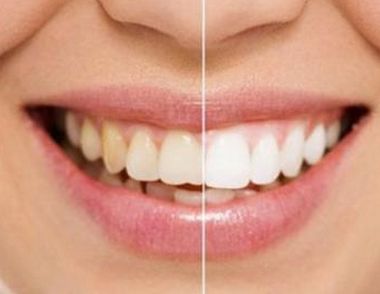 美白牙齿的方法有哪些 教你如何拥有一口大白牙