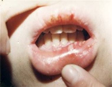 口腔潰瘍有哪些原因 如何區分口腔潰瘍和口腔癌