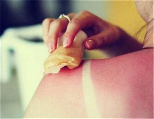 皮膚曬傷以後需要注意什麼 你是否走進了曬傷的誤區