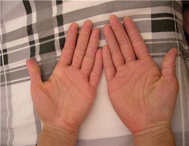 夏季手脫皮是什麼原因引起的 夏天手脫皮怎麼治療