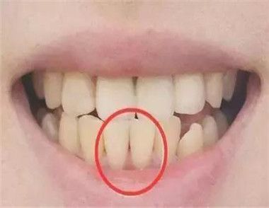 如何預防牙齒變黃 喝礦泉水可以預防牙齒變黃