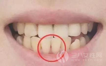 如何预防牙齿变黄 喝矿泉水可以预防牙齿变黄.jpg