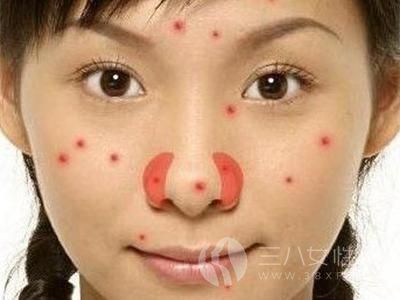 女生臉上長痘的原因 女生臉上長痘可以怎麼做.jpg