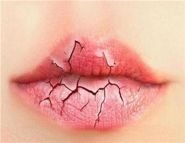 嘴唇起皮什么原因 嘴唇起皮怎么处理