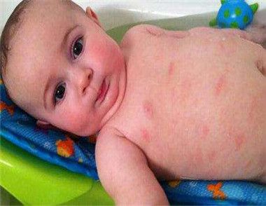 寶寶濕疹是怎麼引起的 寶寶得了濕疹怎麼辦