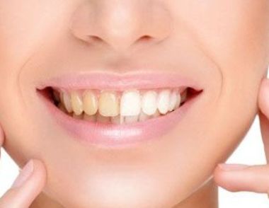 牙齒變黃是什麼原因 怎麼給牙齒美白