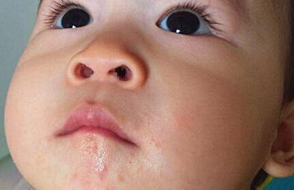 寶寶皮膚過敏是什麼原因 寶寶皮膚過敏怎麼辦